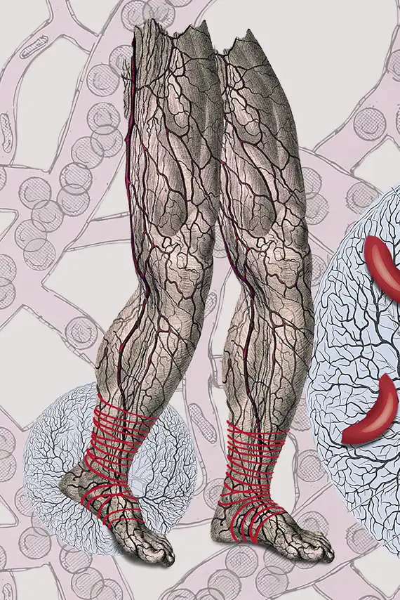 Sobrellevar el dolor cuando se tiene anemia falciforme