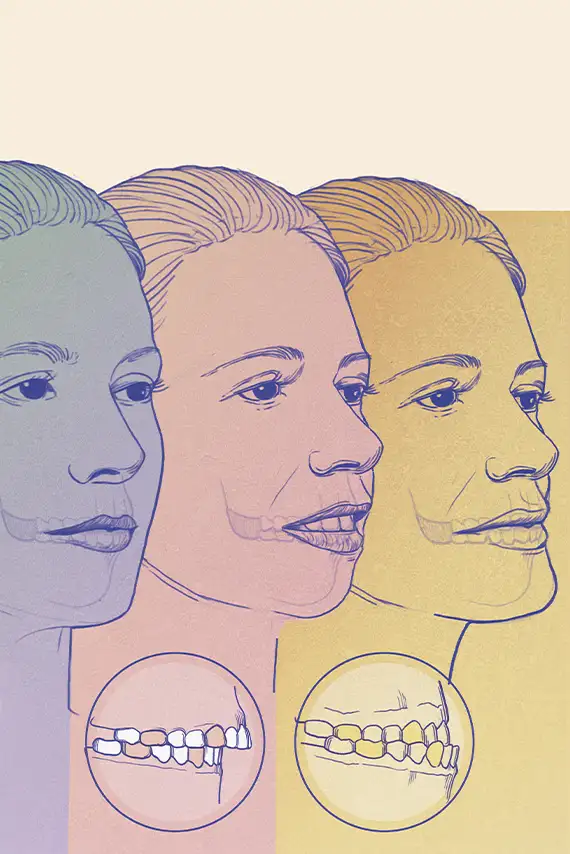Maloclusiones: cuando la mordida impacta mucho más que la sonrisa