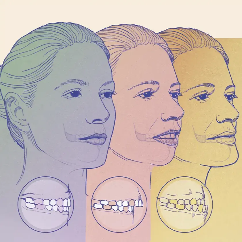 Maloclusiones: cuando la mordida impacta mucho más que la sonrisa
