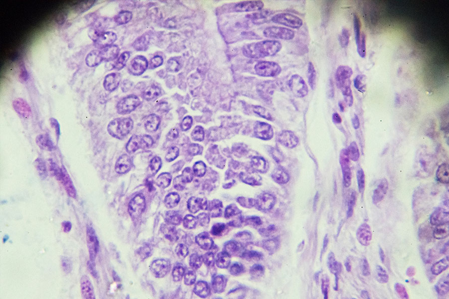 Adenomiosis CUERPOTEXTO