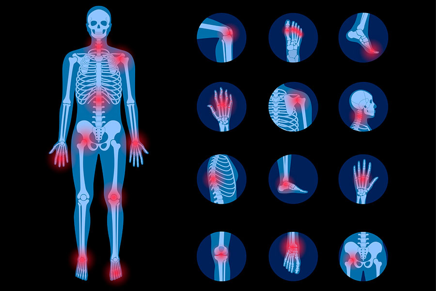 ARTRITIS CUERPOTEXTO