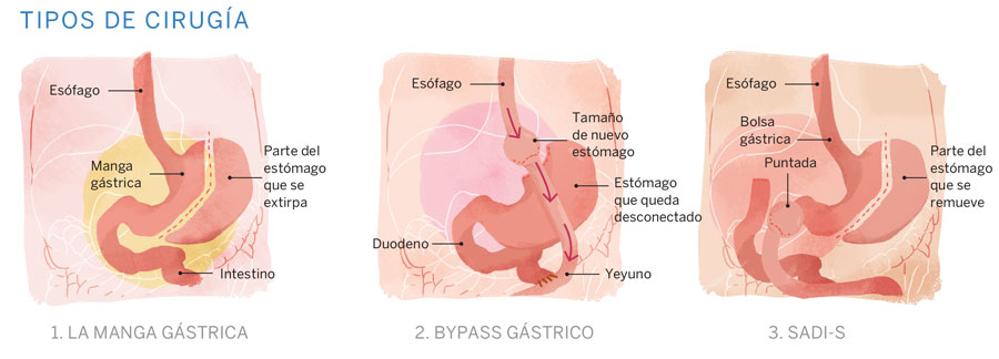 ObesidadCuadroCUERPOTEXTO