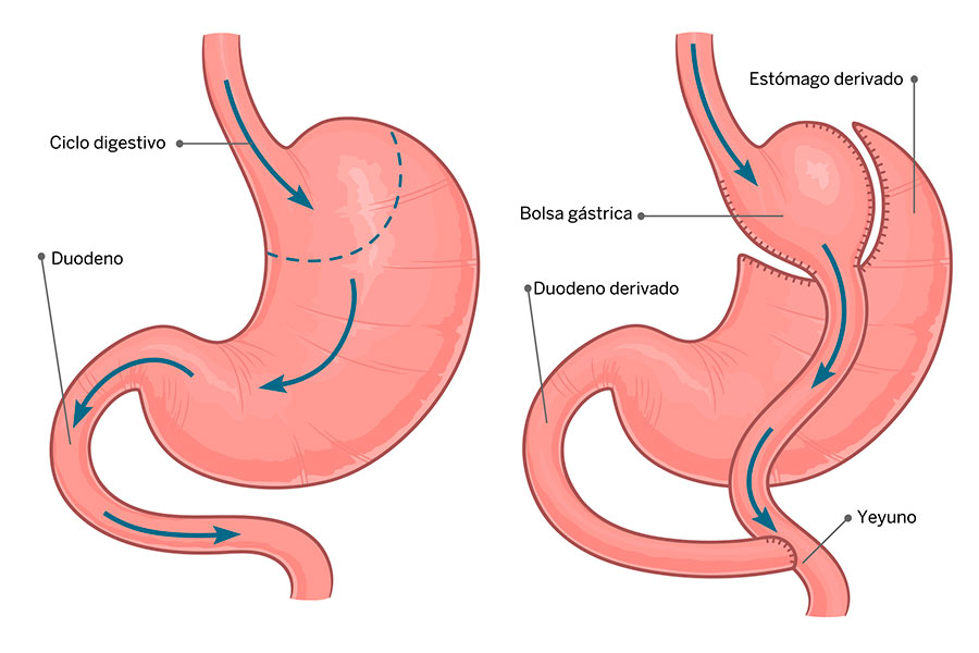 BYPASS CUERPOTEXTO