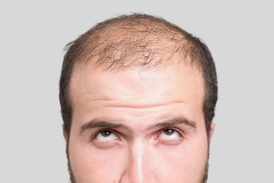Cómo prevenir la alopecia