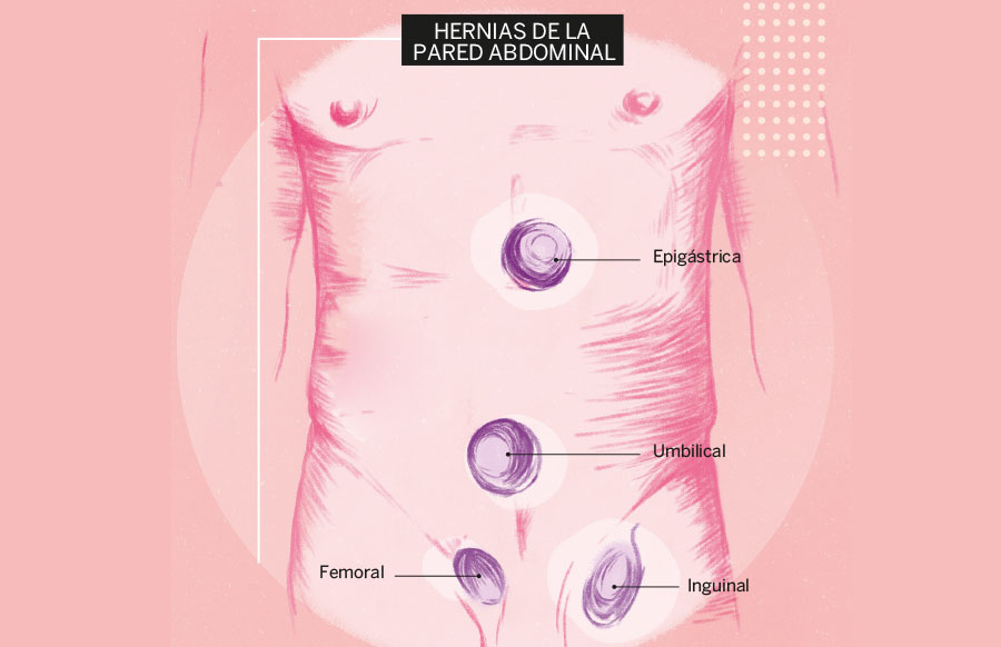 Cuidado con las silenciosas hernias - Luisa Reyes