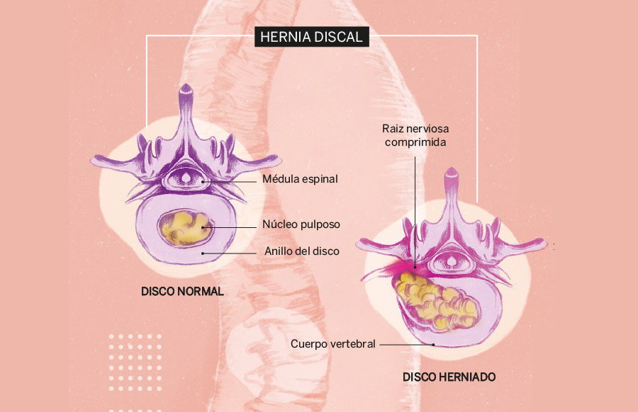 Cuidado con las silenciosas hernias - Luisa Reyes