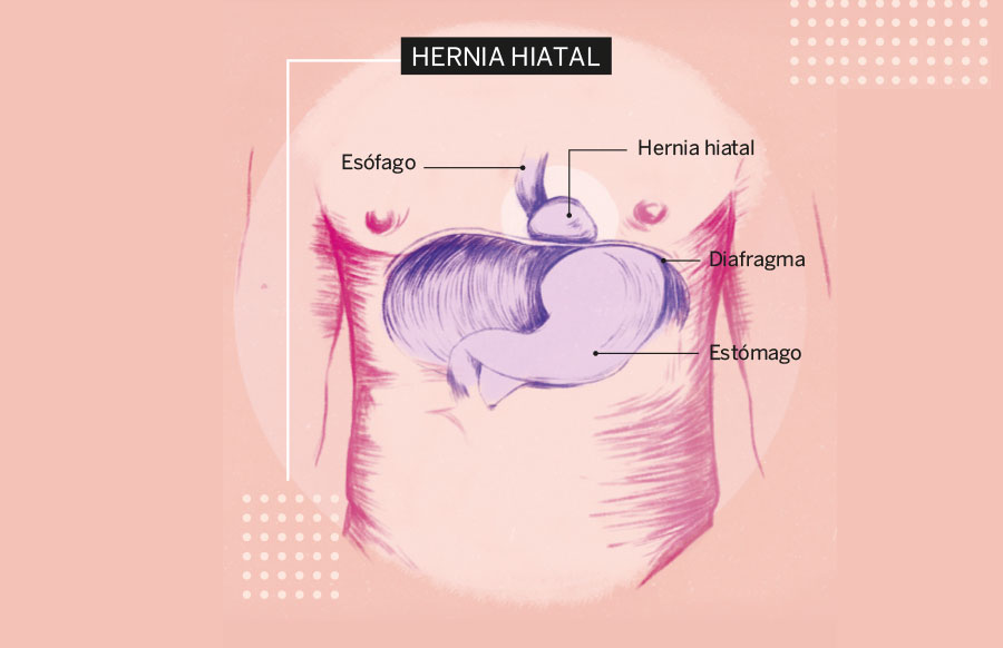 Cuidado con las silenciosas hernias - Luisa Reyes