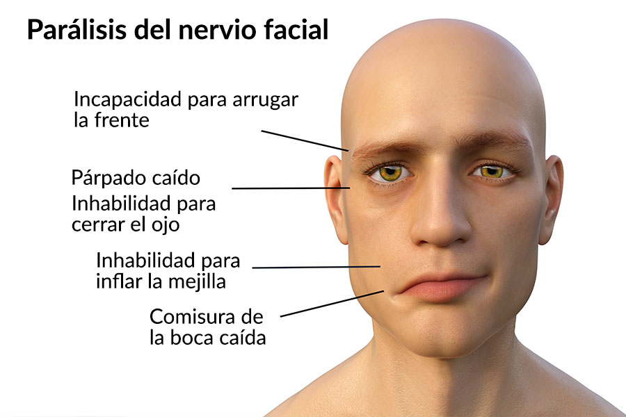 Paralisis facial CUERPOTEXTO