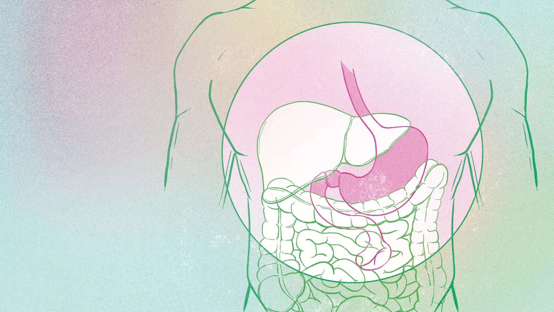 cirugía bariátrica