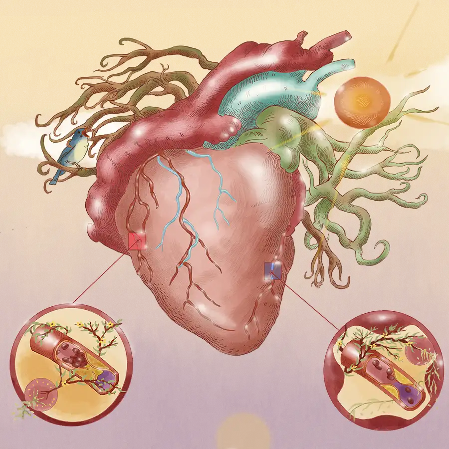 tipos de infarto