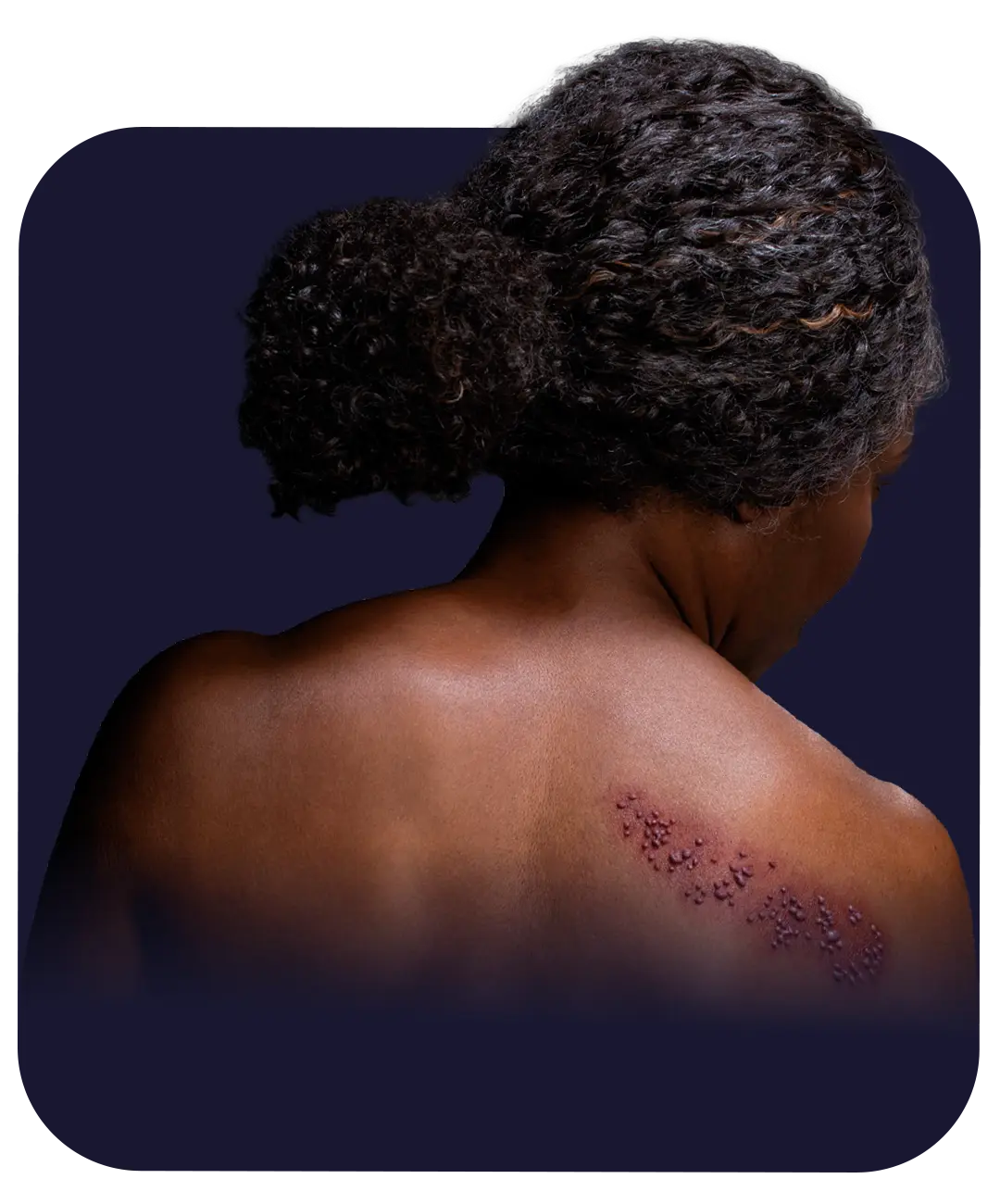 herpes zóster o culebrilla