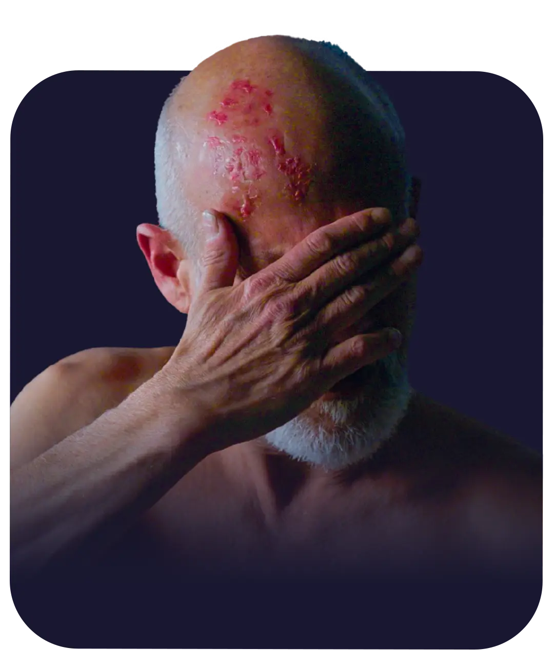 herpes zóster o culebrilla
