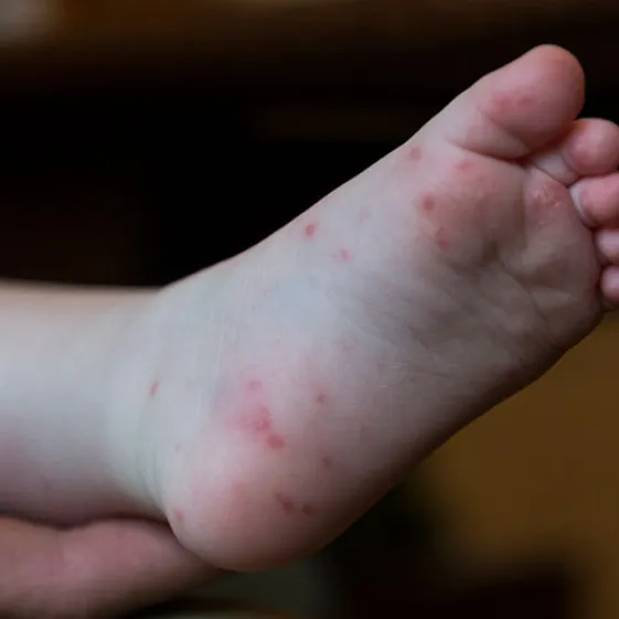 ¿Qué es la enfermedad de manos, pies y boca?