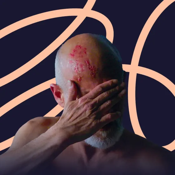 herpes zóster o culebrilla
