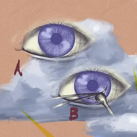 Trasplante de córnea