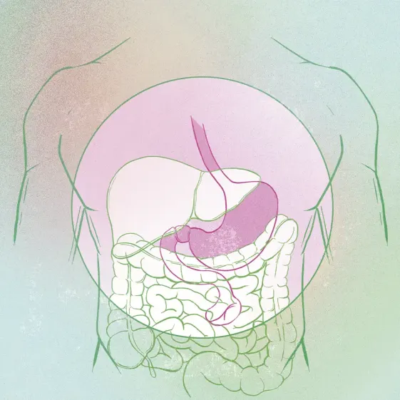 cirugía bariátrica