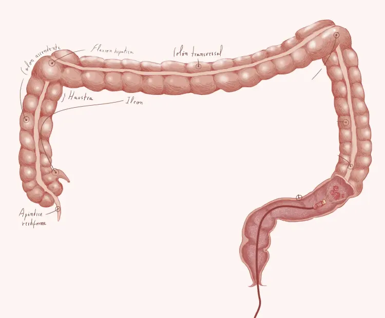 cáncer de colon