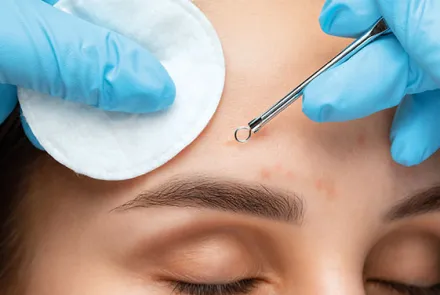 Los beneficios de la limpieza facial profunda