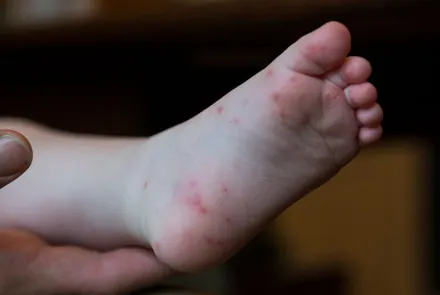 ¿Qué es la enfermedad de manos, pies y boca?