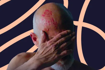 herpes zóster o culebrilla