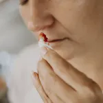 hemorragias en la nariz